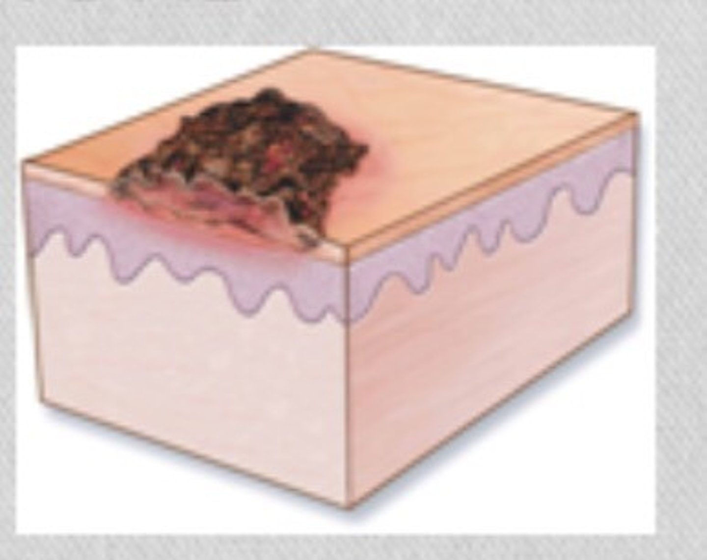 <p>The thickened, dried-out exudate left when vesicles/pustules burst or dry up. Examples: impetigo or scab after abrasion.</p>