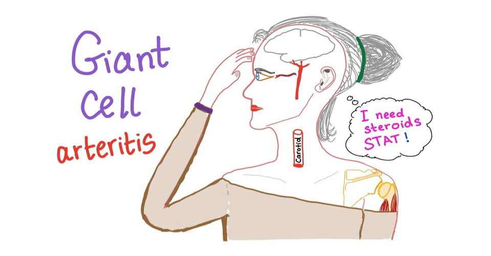 <p>Giant Cell (Temporal) Arteritis</p>
