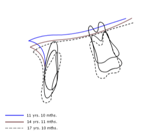 <p>does the maxilla also have rotational growth patterns </p>