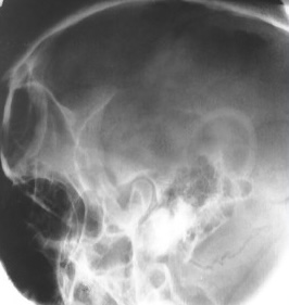 <p>What is this x-ray demonstrating?</p>