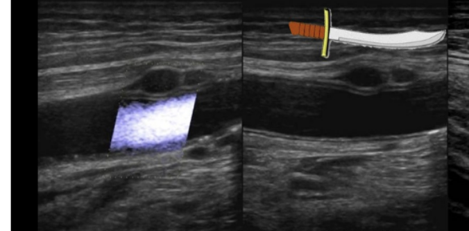 <p>The Scimitar sign is associated with</p><p>.</p><p>a) femoral-femoral bypass graft</p><p>b) bovine arch</p><p>c) median arcuate ligament syndrome </p><p>d) adventitial cysts </p>