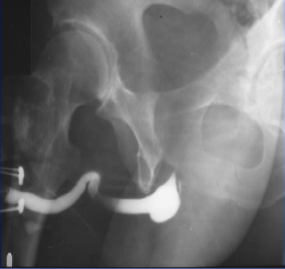 <p>What is this X-ray demonstrating?</p>