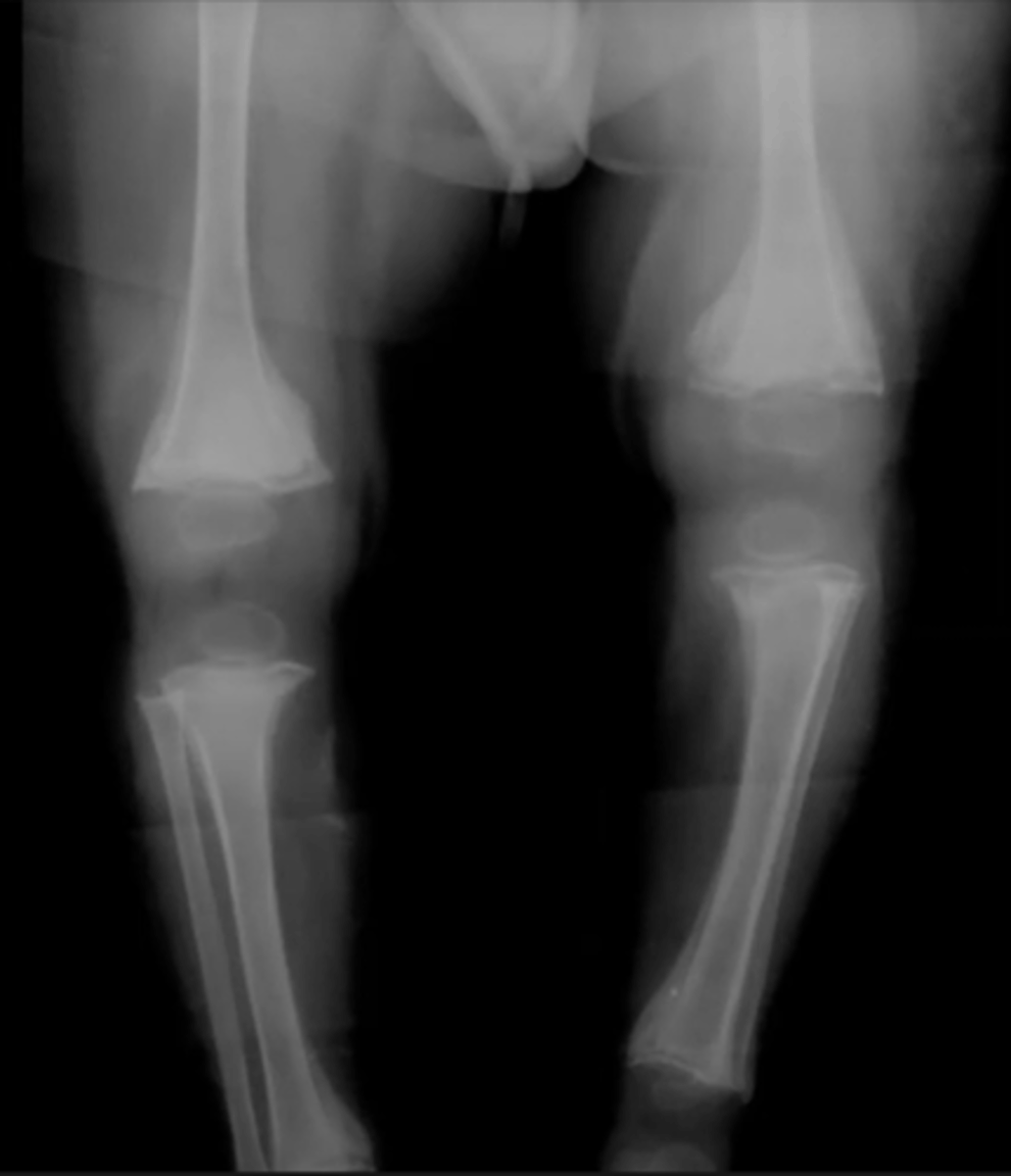 <p>What is this?</p><p>Ex. 8-14 mo pt with Vit C deficiency</p>