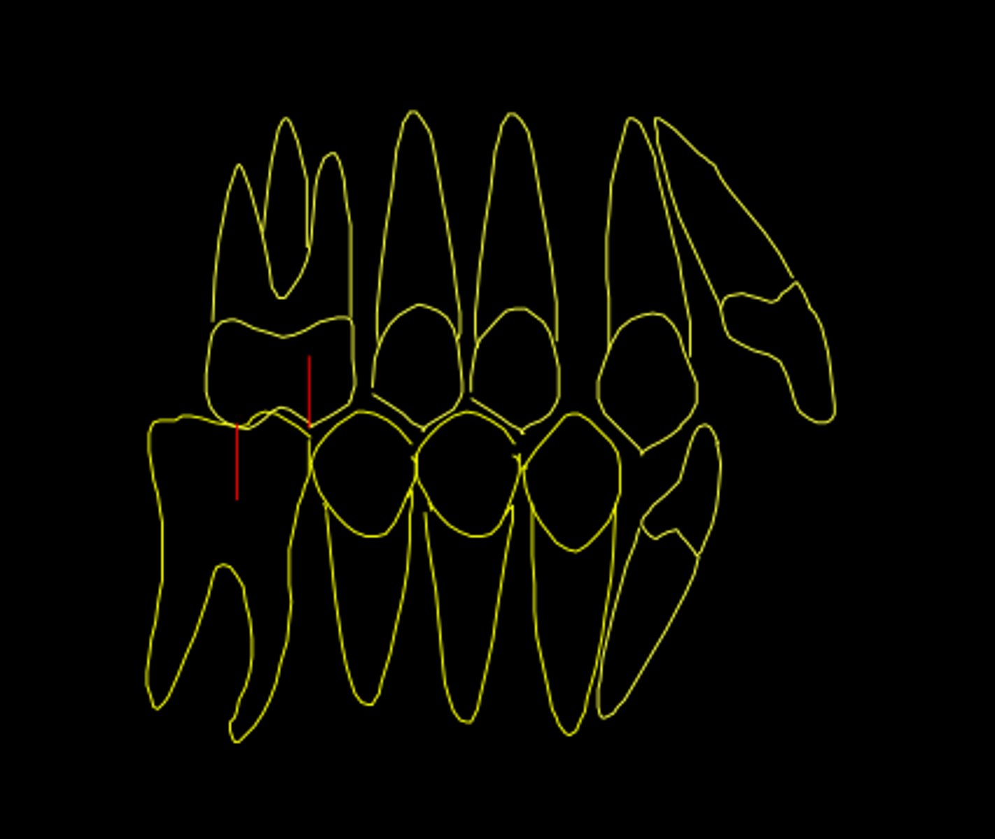 <p>ID the class of occlusion:</p>
