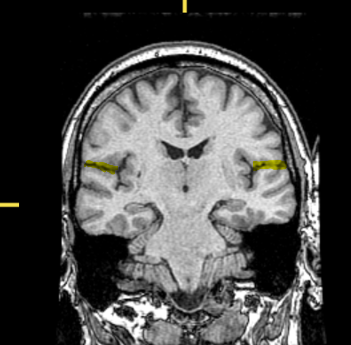 <p>What part of the brain is highlighted?</p>