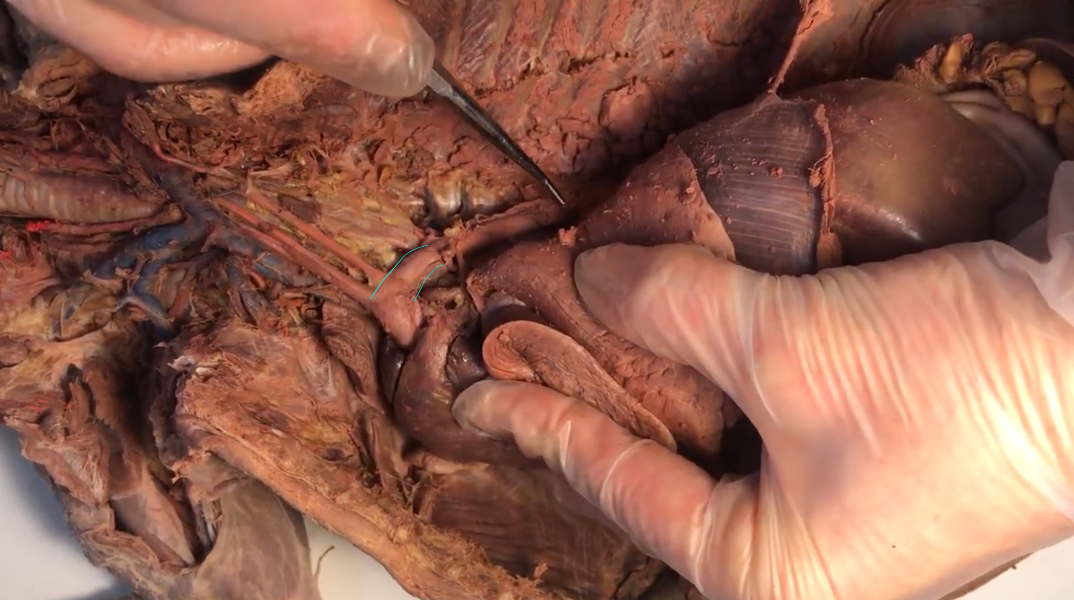 <p>What artery is this</p>