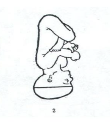 <p>can still deliver vaginally;<strong> head is neutral </strong>aka “looking straight”; diameter is wider making descent slower/more difficult</p>