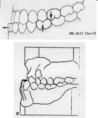 <p>Class III</p>