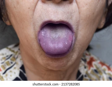 <p>a type of cyanosis caused by decreased arterial oxygenation, best observed in the buccal mucous membranes and lips (e.g., pulmonary or cardiac disease). </p>