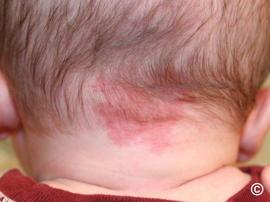 <p>Capillary malformations found on eyelids, between eyebrows or nape of neck. Usually fade within 1-2 years of life</p>