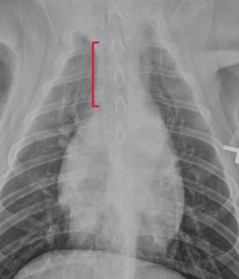 <p>From the first ribs to the cranial aspect of the heart</p>