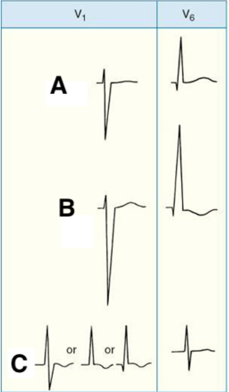 <p>A, Normal</p><p>B. LVH</p><p>C. RVH</p>