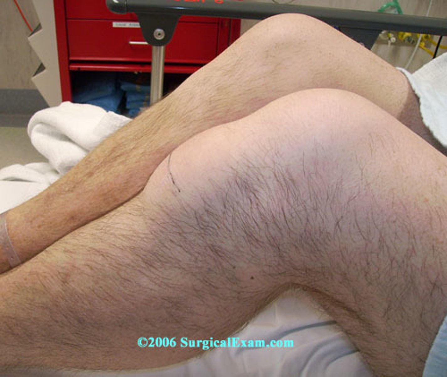 <p>Superficial infrapatellar bursitis </p>