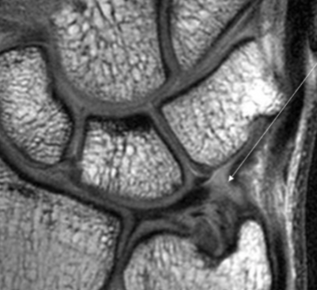 <p>Describe the pathology indicated by the arrow (Cor PD). </p>