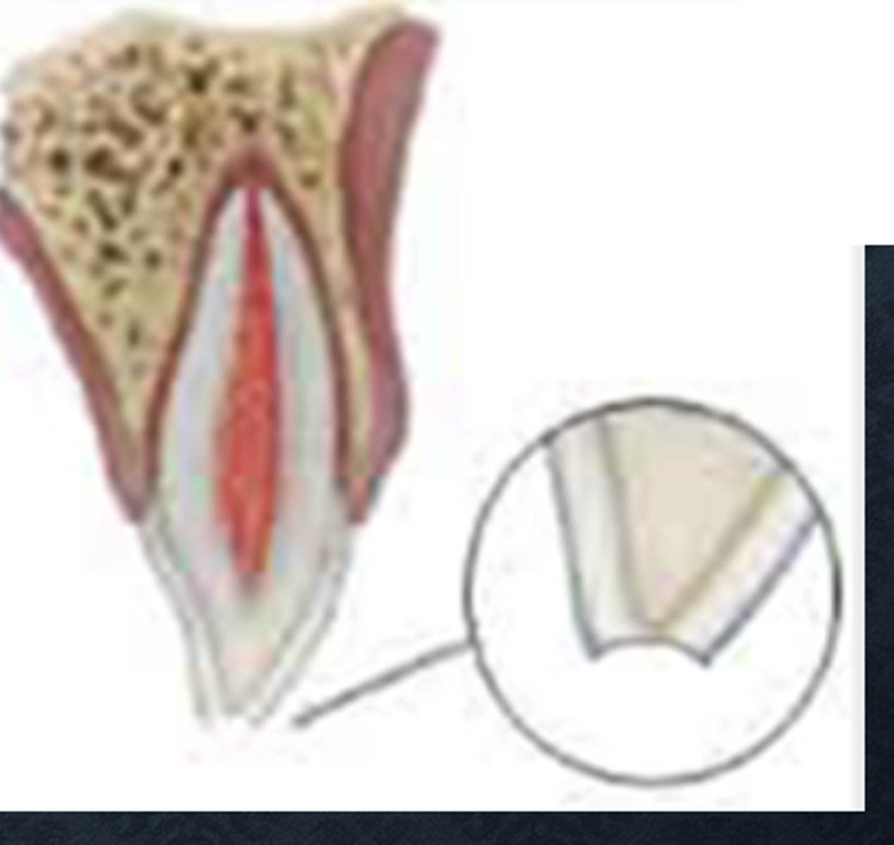 <p>Enamel fracture or enamel-dentin fracture that does NOT involve the pulp</p>