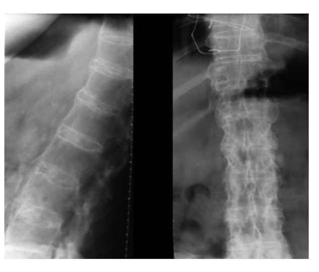 <ul><li><p>syndesmophytes à plusieurs étages </p></li><li><p>Aspects de «&nbsp;colonne bambou&nbsp;» </p></li></ul><p></p>