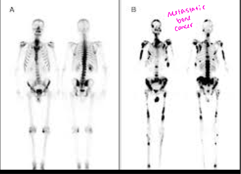 <p>99mTc-MDP- taken up in areas of osteoblastic activity and is used to evaluate bone pathology, CANCER (blast)</p>