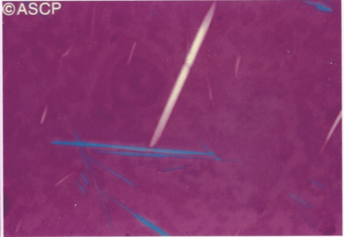 <p>Identify the crystals in this body fluid</p>