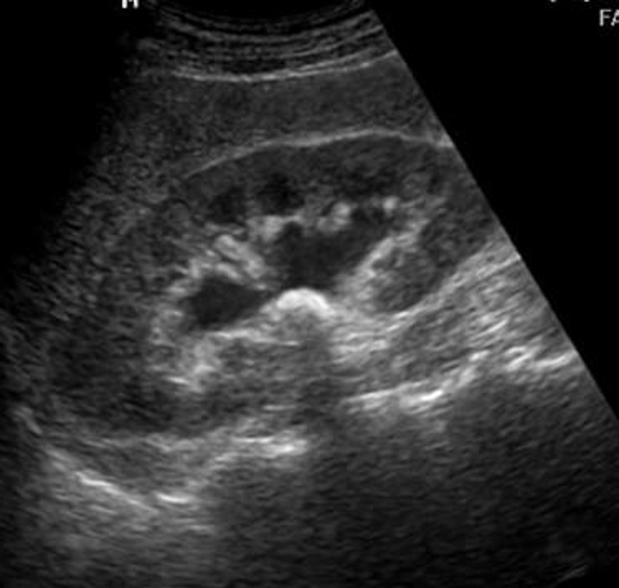 <p>pyelo</p><p>hydronephrosis</p>