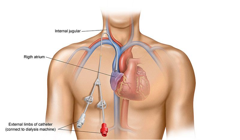 <ul><li><p>central venous catheters</p></li><li><p>temprary access only</p></li><li><p>inserted into jugular, femoral, subclavian vein</p></li><li><p>use for emergent dialysis</p></li><li><p>or when AV graft or AV fistula are no longer an option</p></li></ul><p></p>