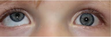 <p>This is a picture of the following condition:</p>