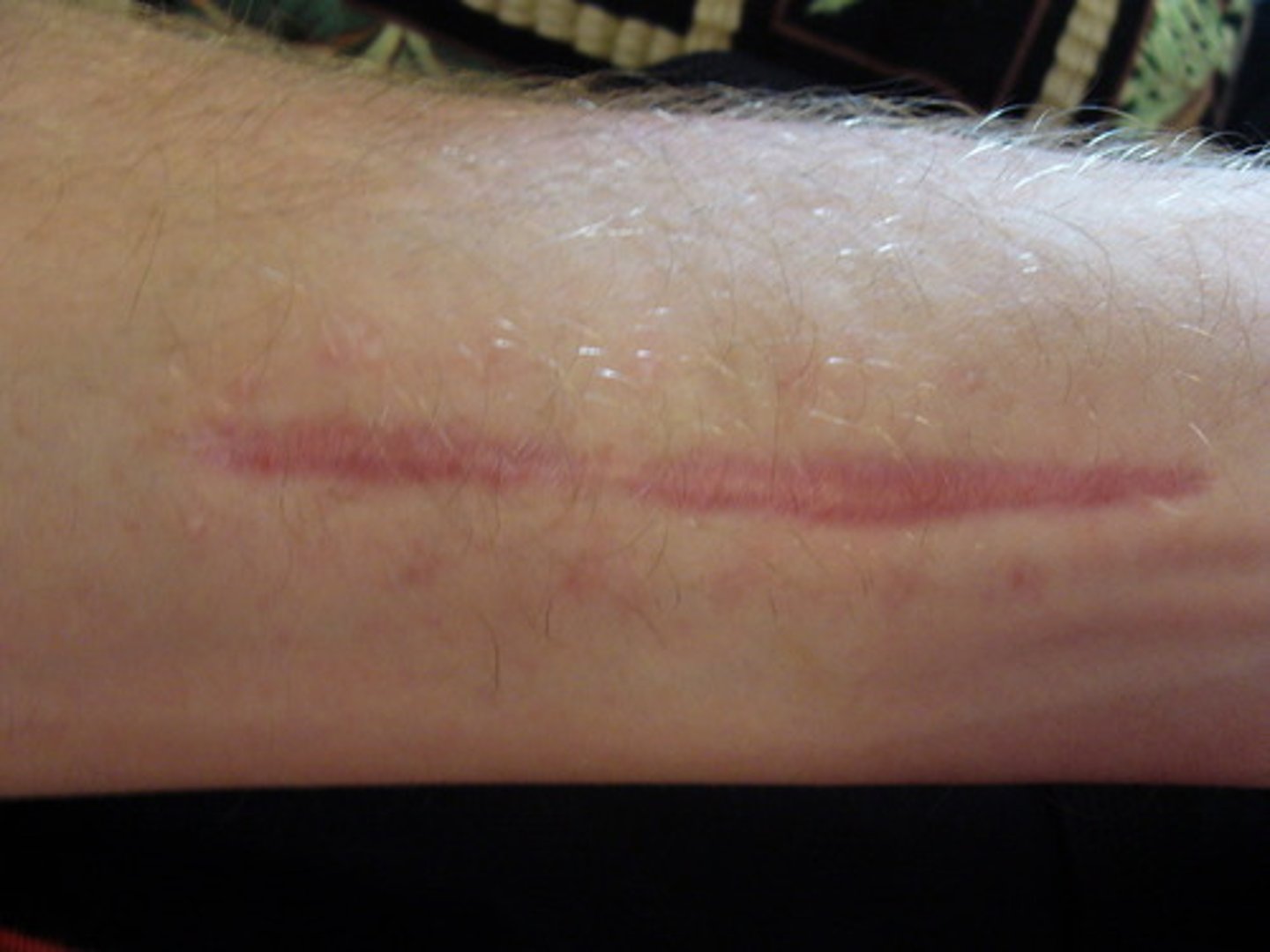 <p>A mark on the skin that is left after a cut or other wound has healed.</p>