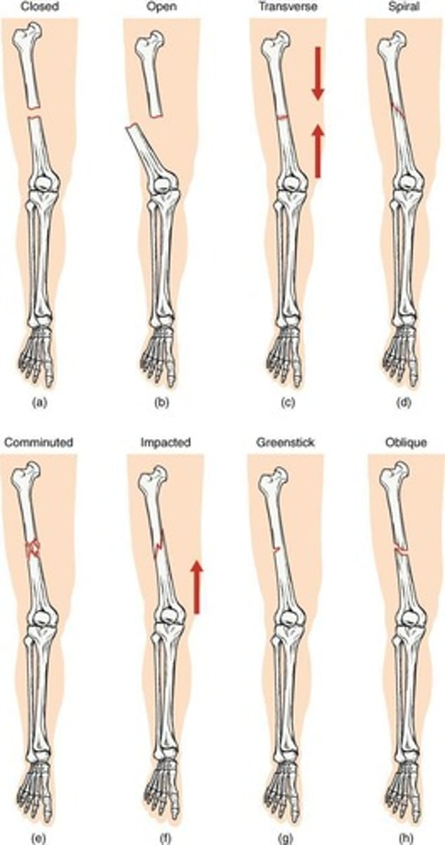 <p>Based on location, severity, completeness (complete/incomplete), and whether the skin is penetrated (open/closed).</p>