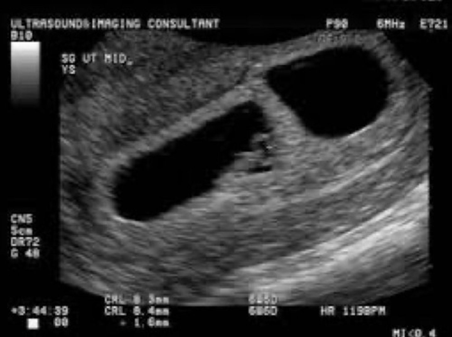 <p>25% of monozygotic twins</p><p>Divides between 0-3 days</p><p>10% mortality rate</p>