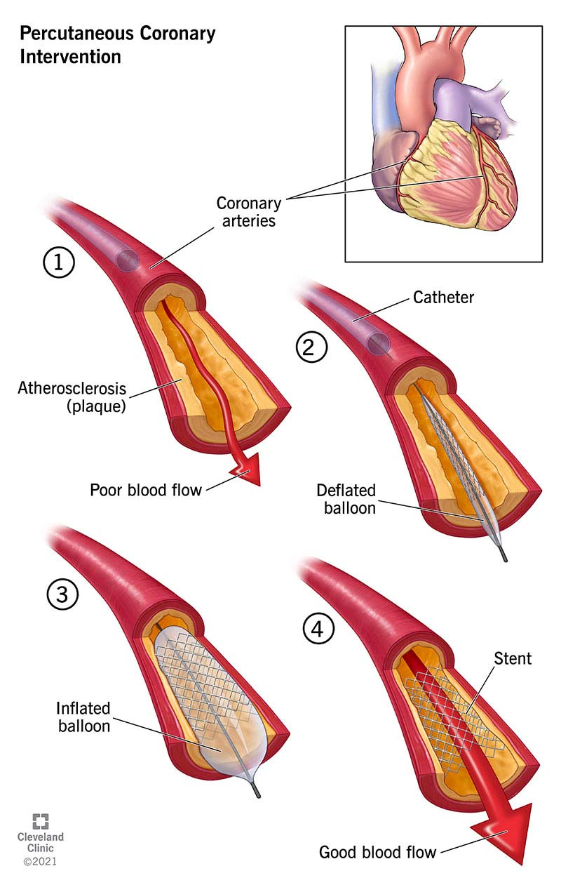 <p><strong>Percutaneous Coronary Intervention (PCI)</strong></p><p>-Minimally invasive ___________ procedure performed to improve blood ____ in one or more segments of coronary ___________</p><p>-Can be used for evaluation/interventional treatment for ___________ heart disease like adult congenital heart disease or valvular heart disease</p><p>-Most commonly used revascularization procedure </p><p>-Primarily involves the use of ________ angioplasty + intracoronary stenting </p>