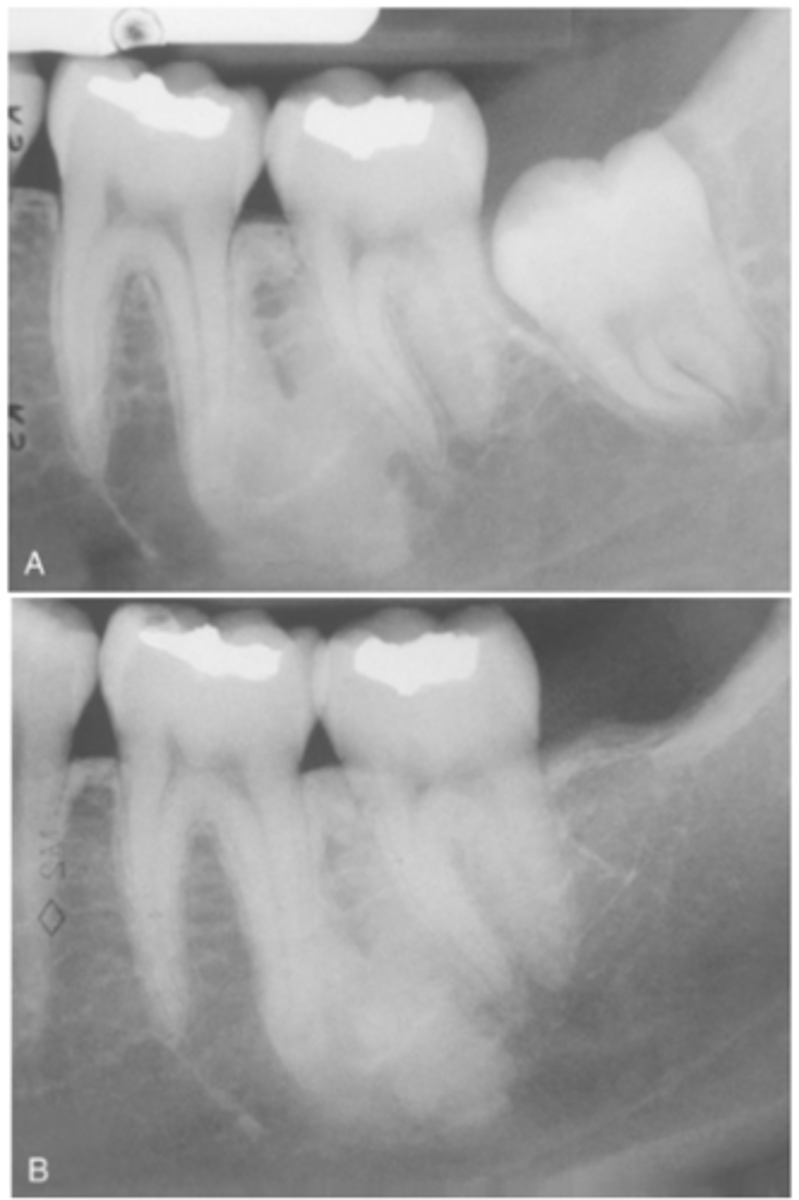 <p>Is Idiopathic Osteosclerosis usually symptomatic or asymptomatic?</p>