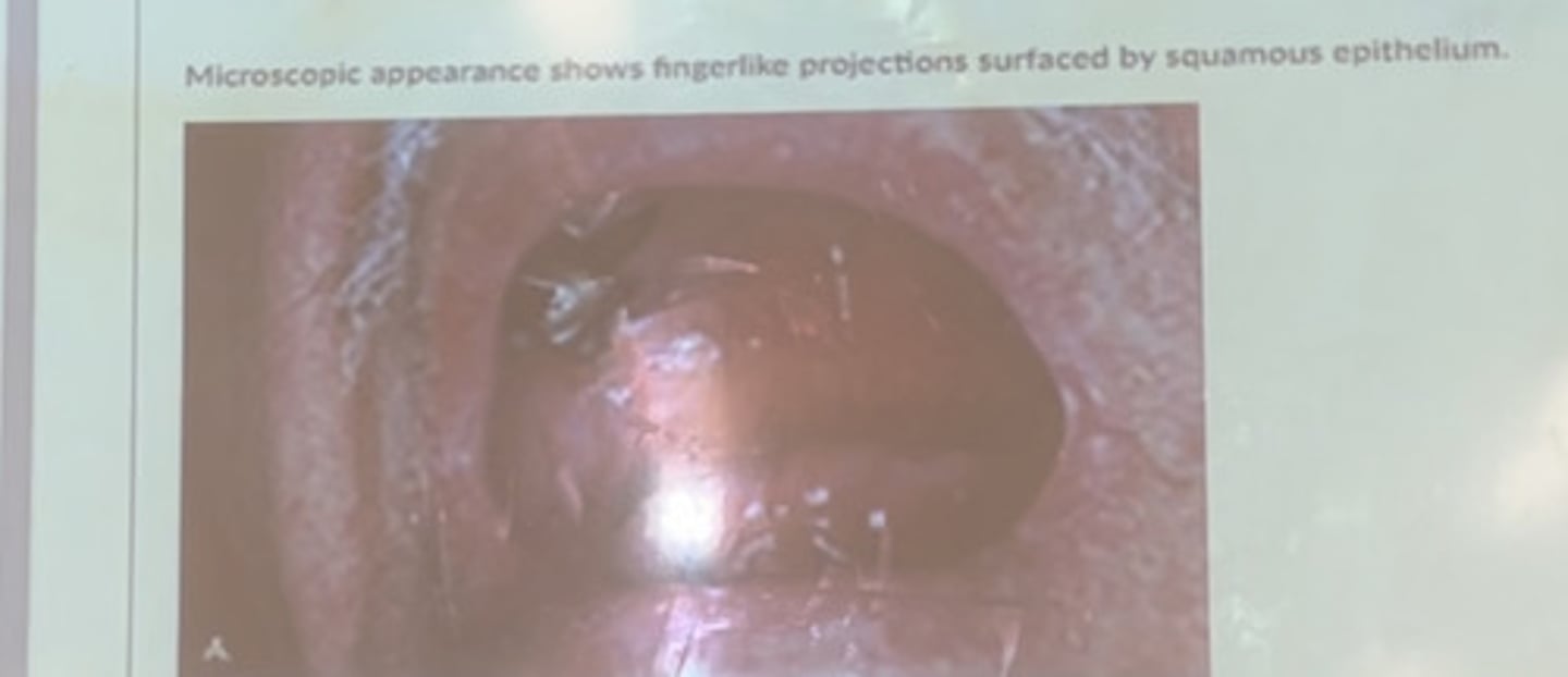 <p>Microscopic appearance shows fingerlike projections surfaced by squamous epithelium</p>