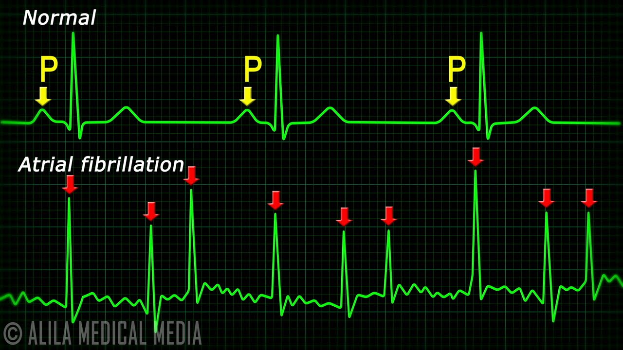 <p>waves undisguisable, chaotic rhythm, all cells have different electrical impulses and beat out of sync</p>