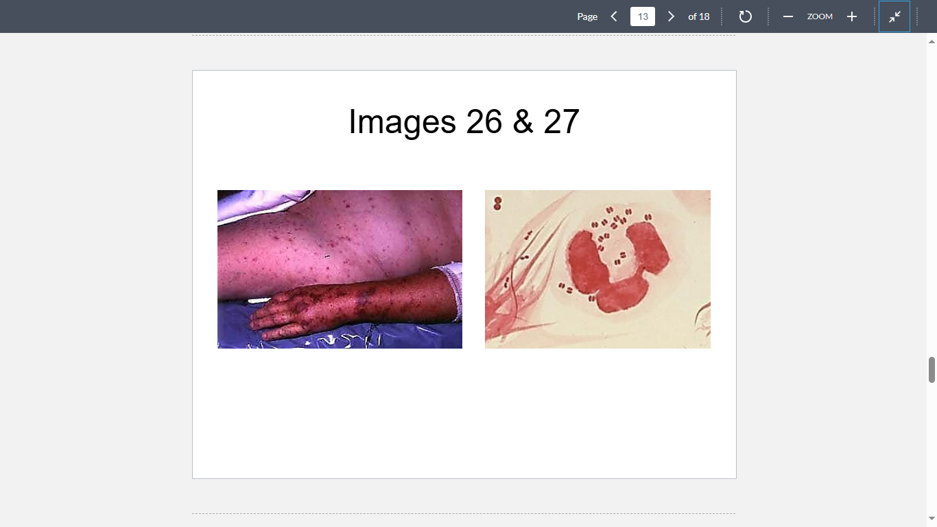 <p>This patient (Image 26) was first diagnosed with meningitis, followed by meningococcemia. Gram stain of a CSF sample yielded these organisms (Image 27). Despite appropriate management, he died of complications of diffuse intravascular coagulopathy, including Waterhouse-Friderichsen syndrome. On autopsy, he was found to have:</p>