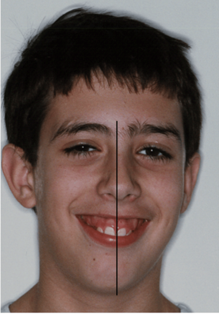 <p>How would you describe the cephalic index for this patient?</p>