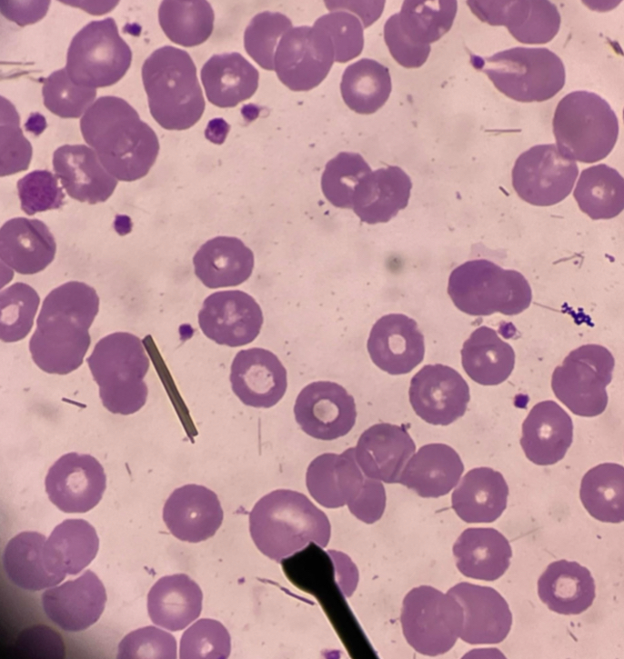 <p>A. Identify the pointed cell</p><p>B. Describe the striking feature</p><p>C. Associated with what conditions?</p><p>D. What are the other associated conditions?</p>