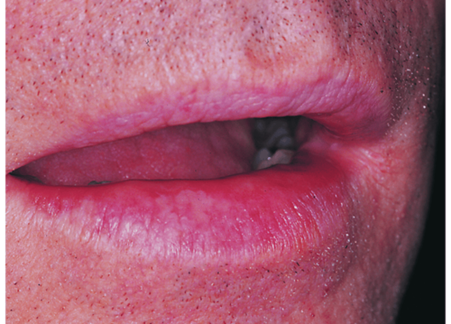 <p>Degeneration of the tissue of the lips, caused by exposure to the sun; Smoking & alcohol use increase risk of squamous cell carcinoma</p>