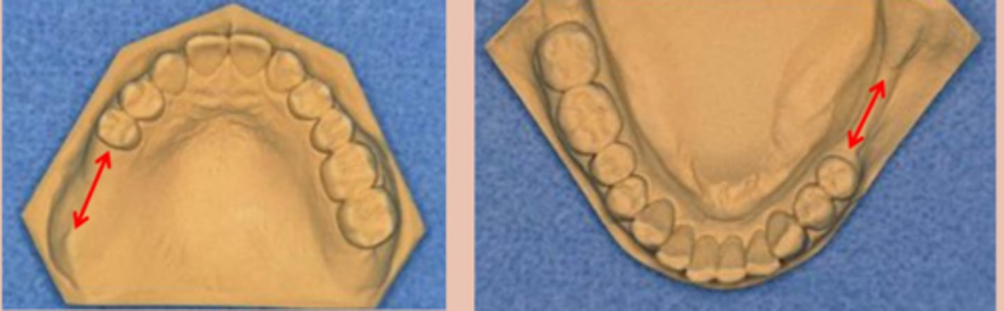 <p>Tooth and tissue supported:</p><p>unilateral edentulous area located posterior to the natural teeth</p>