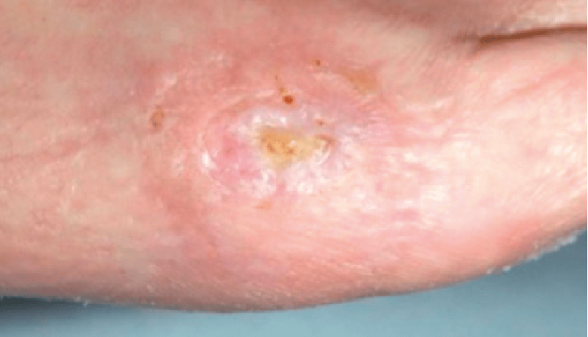<p>New pink &amp; shiny tissue/skin that grows in from the edges or as islands on the wound surface</p>