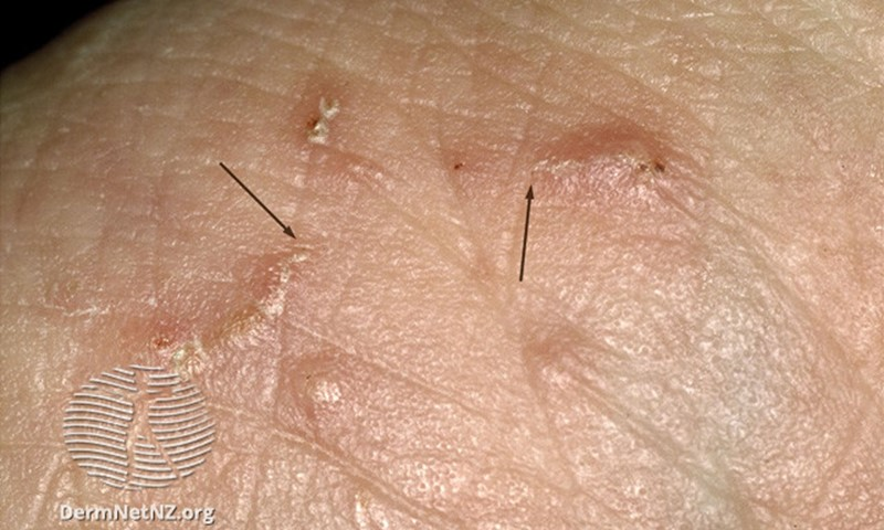 <ol><li><p>intense itching </p></li><li><p>pimple like rash, often visible burrows </p></li></ol><p></p>