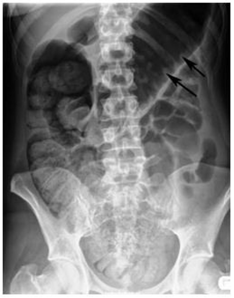 <p>Plan abd x-rays and 3 of the following:</p><p>- Fever > 38 (100.4)</p><p>- Pulse > 120/min</p><p>- WBC > 10, 500</p><p>- anemia</p><p>tx: IV steroids, NG decompression, abx, and fluids</p><p>Risk factors: IBD, C. difficile</p>