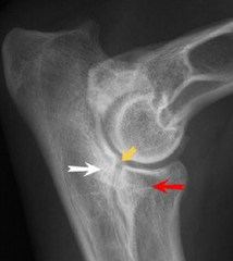 <p>You see this on a radiograph of a dog with fragmentation of the medial coronoid process. Can it be taken into surgery?</p>