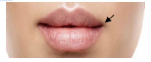 <p>This is the structure where the upper and lower lips meet?</p><p>A. Cupid’s bow</p><p>B. Vermillion border</p><p>C. Oral commissure</p><p>D. Philtral ridge</p>