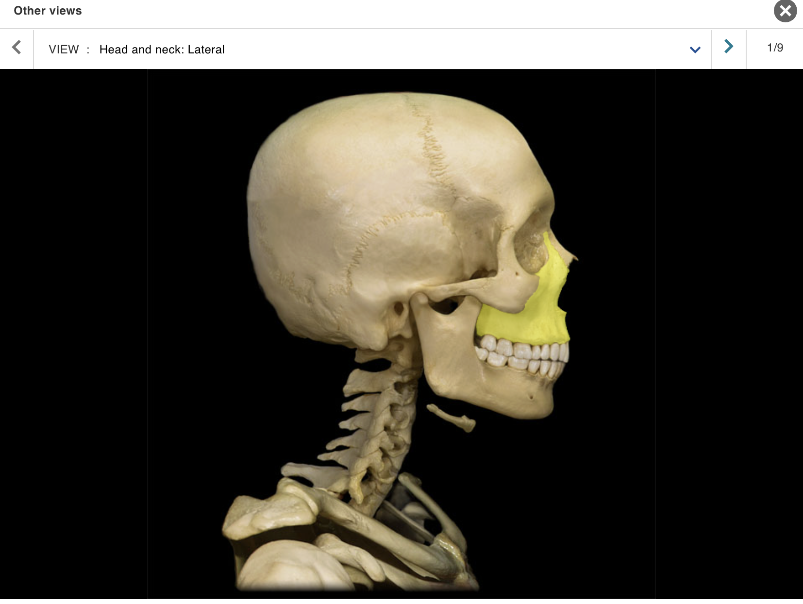 <p>Location:</p><p class="p1">• Skull (anterior)</p><p class="p1">Description:</p><ul><li><p>﻿﻿Paired, irregular-shaped bone</p></li><li><p>﻿﻿Left and right maxillae unite to form "upper jaw"</p></li><li><p>﻿﻿Contains alveoli ("sockets") for teeth</p></li><li><p>﻿﻿Contains maxillary air sinus on each side</p></li></ul><p>Also known as:</p><p class="p1">• "Upper jaw"</p><p class="p1">Comment:</p><ul><li><p>﻿﻿Forms part of floor of orbit and anterior part of hard palate</p></li><li><p>﻿﻿Contributes to upper face</p></li></ul><p></p>