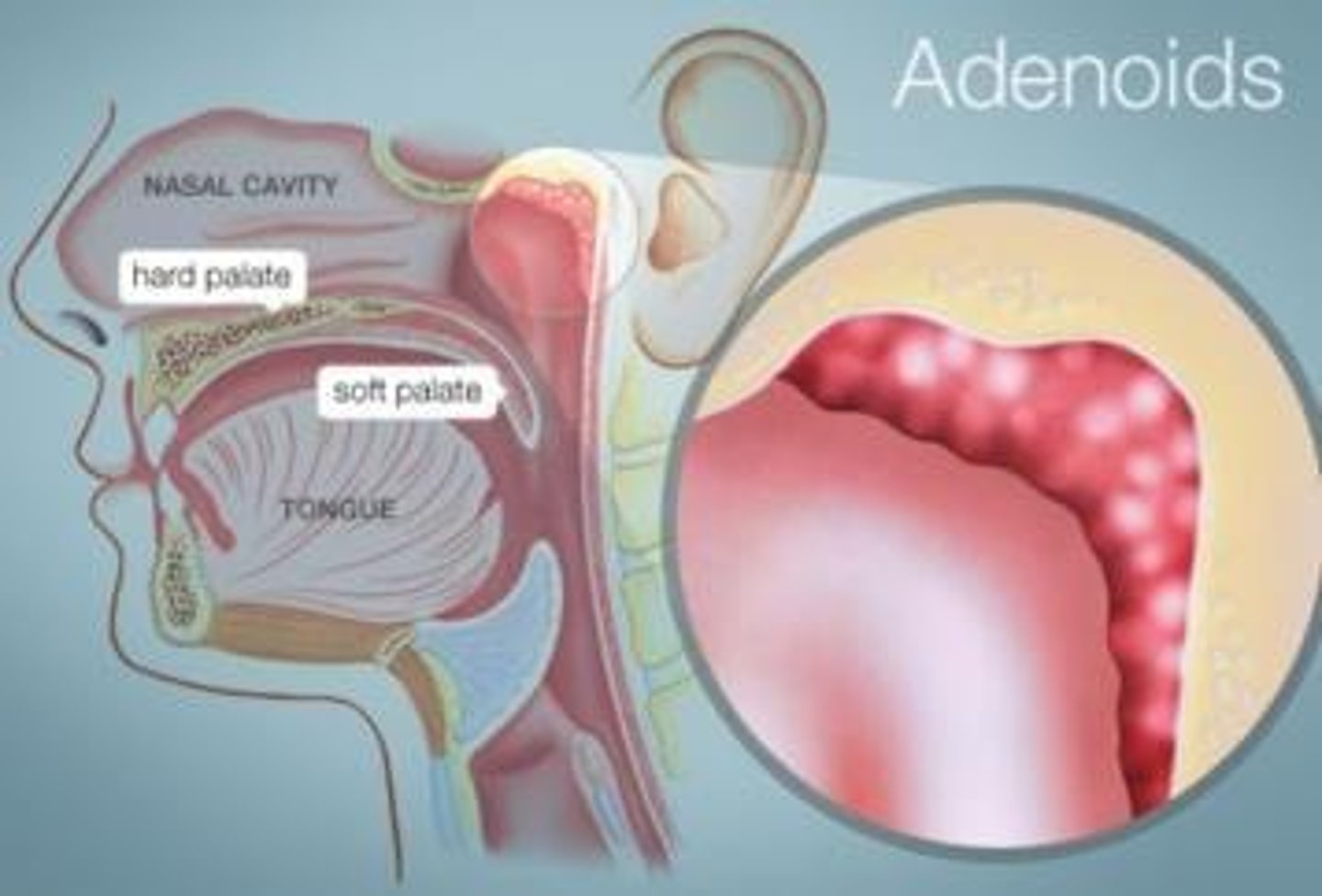 <p>Adenoid</p>