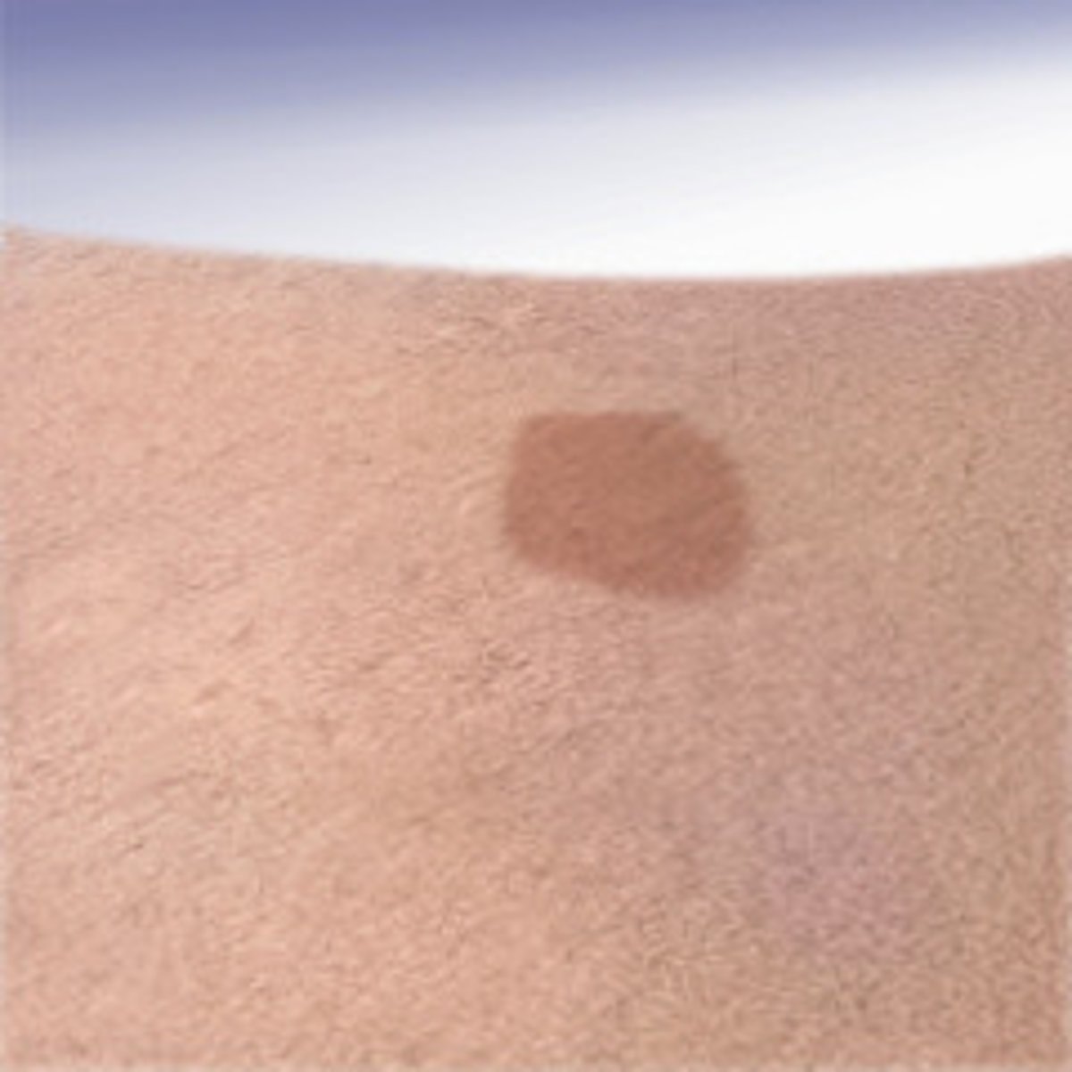 <p>flat, colored spot</p><p><0.5 cm</p>