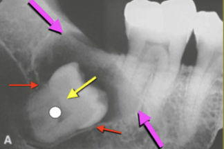 <ul><li><p>Size of <strong>Follicular Space</strong></p></li><li><p>Location of <strong>Cortex Relative to CEJ</strong></p></li><li><p><strong>Displaced 32</strong></p></li><li><p><strong>Impacted Tooth</strong></p></li></ul><p></p>