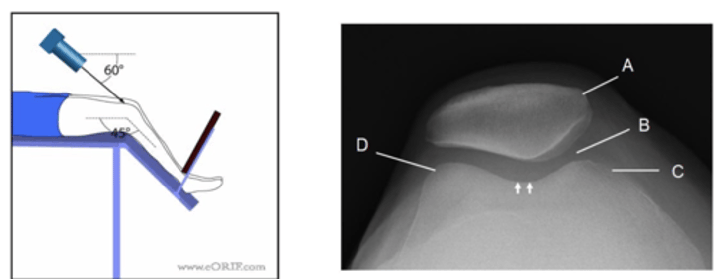 <p>1. The patient sits on the x-ray couch with affected knee flexed over the edge.</p><p>2. If possible the knee should be flexed to 45 degrees.</p><p>3. Patient to lean back whilst keeping affected knee still to avoid primary beam.</p><p>4. The IR should be at the level of the inferior border of the tibial tuberosity</p>