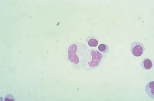 Figure 7: Normal lymphocytes and monocytes