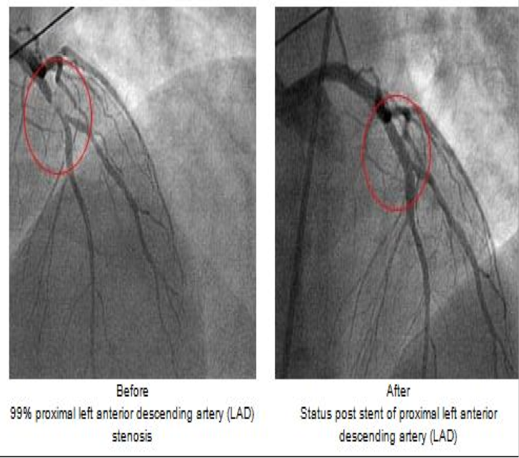 <p>Fluoroscopy used as an adjunct to see the flow of blood through the coronary arteries in order to evaluate the presence of arterial blockages</p>