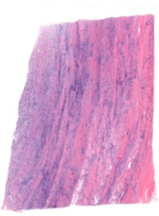 <p>A mix of hyaline cartilage and regular connective tissue</p><p>combines collagen fibre tensile strength with resistance compression of cartilage. Found where tendons attach to bones, minisci and intervertebral disks</p><ul><li><p>Collagen fibres (type 1 and 2, stained pink/red)</p></li><li><p>fibroblasts - scattered w/in fibrous regions with elongated/flattened nuclei</p></li><li><p>chondrocytes - dispersed either singularly or in isogenous groups</p></li><li><p>matrix - much less surrounds each chondrocyte than in hyaline cartilage - type 2 collagen and proteoglycan ground substance. Basophilia is due to a high content of sulfated glycoaminoglycans (GAGs)</p></li><li><p>No perichondrium</p></li></ul><p></p>